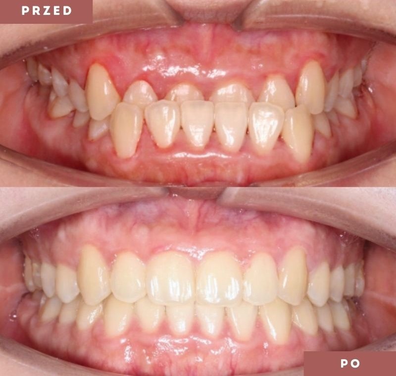 Nakładki ortodontyczne – efekty leczenia przed i po